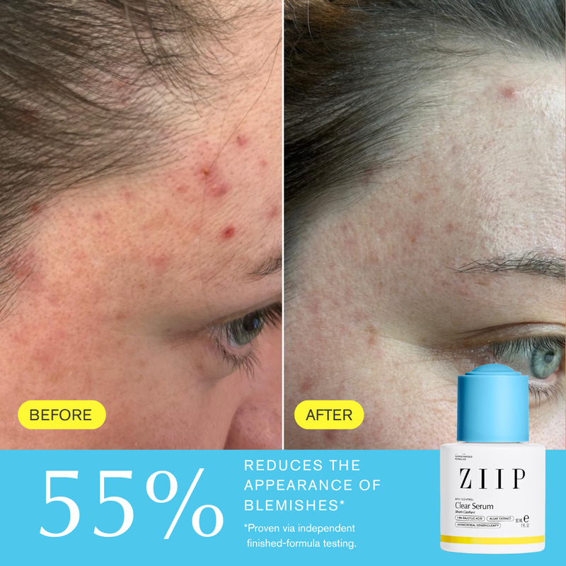 ZIIP Clear Salicylic Acid Serum